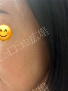 治療直後の症例写真