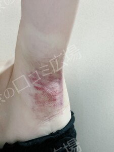 治療直後の症例写真