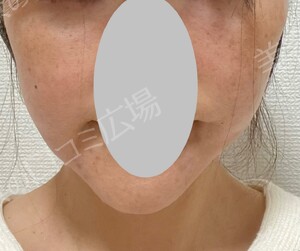 治療直後の症例写真