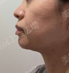 ボルニューマ｜フェイスラインのたるみの治療結果の症例写真