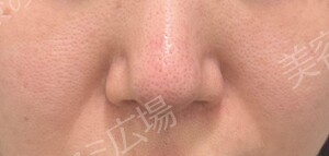 ギャラリークリニックのシミ・肝斑の症例写真[ビフォー]