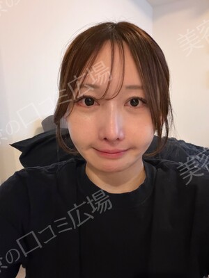 エバーグリーンメディカルクリニックのシミ・肝斑の症例写真[ビフォー]