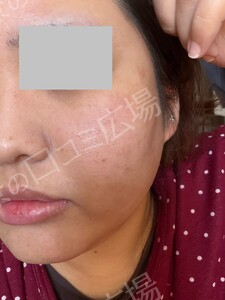 治療直後の症例写真
