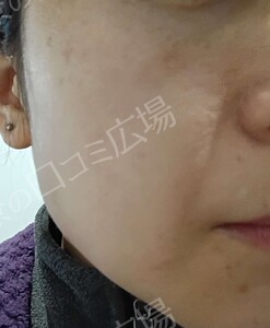 治療直後の症例写真