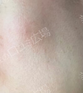 治療前の症例写真