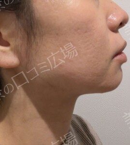 医療ハイフ｜頬・フェイスラインのたるみの治療直後の症例写真