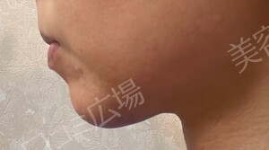 治療直後の症例写真