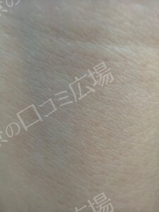 治療直後の症例写真