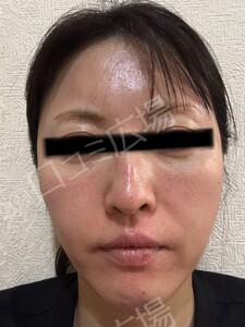 治療直後の症例写真