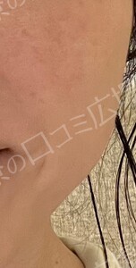 治療前の症例写真