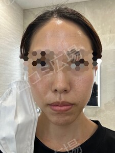 治療直後の症例写真