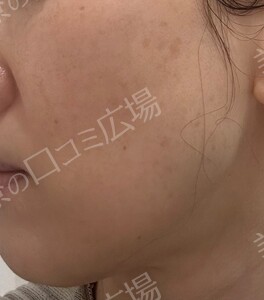 治療直後の症例写真