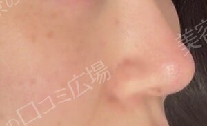 ハイドラジェントル｜毛穴の黒ずみを集中的に除去の治療直後の症例写真