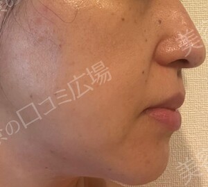 治療直後の症例写真