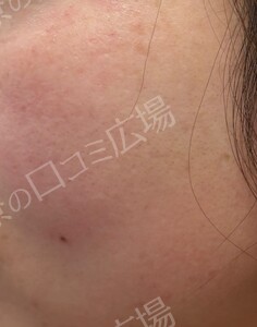 治療直後の症例写真