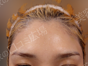 治療直後の症例写真