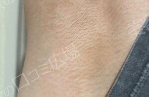 治療直後の症例写真