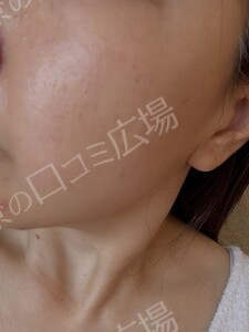 治療前の症例写真
