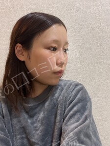 【筒井院長】脱脂術＋ピュアグラフティング　リポキューブの治療結果の症例写真