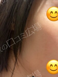 治療直後の症例写真