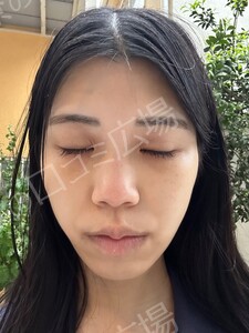 治療直後の症例写真