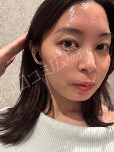 治療直後の症例写真