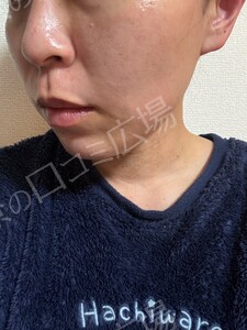 治療前の症例写真