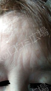 治療結果の症例写真