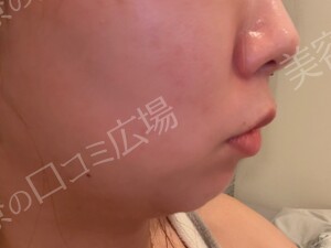 治療直後の症例写真
