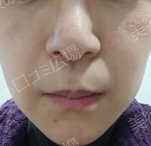 治療直後の症例写真