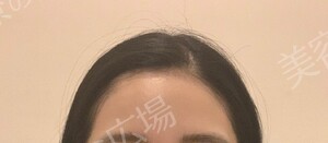 治療直後の症例写真