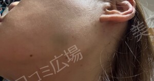 治療直後の症例写真