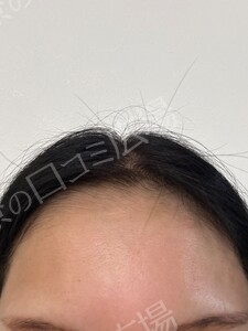 治療直後の症例写真