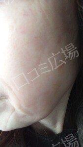 治療直後の症例写真
