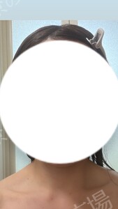治療前の症例写真