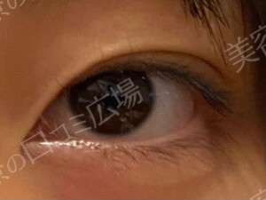 【学生限定】LS法ダブルスタンダードプラン　両目の治療結果の症例写真