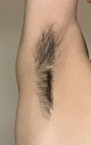美容皮膚科 町田マリアクリニックのわきが・多汗症治療の症例写真[ビフォー]