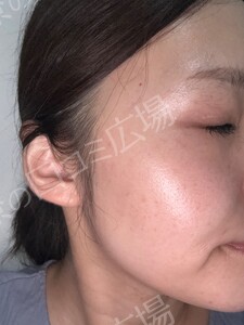 ジェネシスの治療直後の症例写真