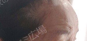 治療直後の症例写真