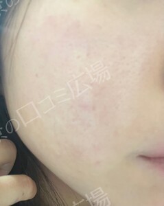 ララドクター｜低刺激ピーリング｜ララピール進化版の治療結果の症例写真