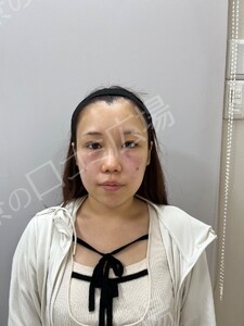 【筒井院長】脱脂術＋ピュアグラフティング　リポキューブの治療直後の症例写真