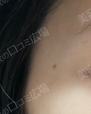 新宿中央クリニックのほくろ除去・あざ治療・イボ治療の症例写真[ビフォー]