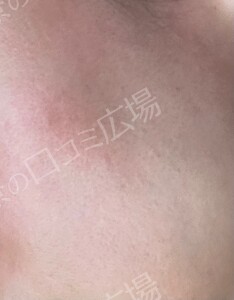 治療直後の症例写真