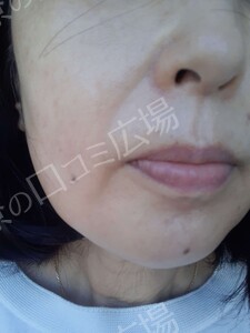 治療前の症例写真