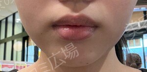 治療直後の症例写真