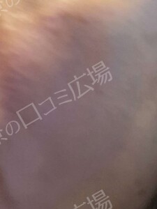 治療直後の症例写真