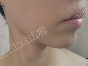 治療直後の症例写真