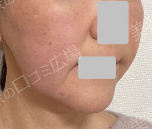 治療結果の症例写真