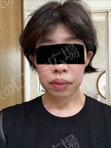 治療直後の症例写真