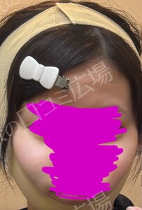 治療直後の症例写真